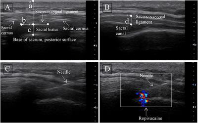 Study on MEV90 of 0.5% ropivacaine for US-guided caudal epidural block in anorectal surgery